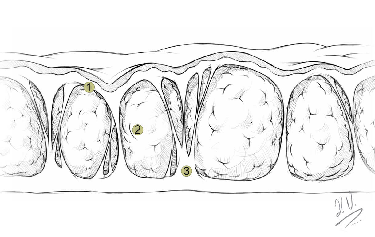 Cellulite treatment Dr. Kelly